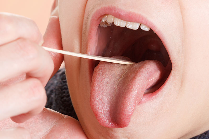 Untersuchung des Mund und Rachens, geöffneter Mund, ein Arzt untersucht die Zunge einer Patientin