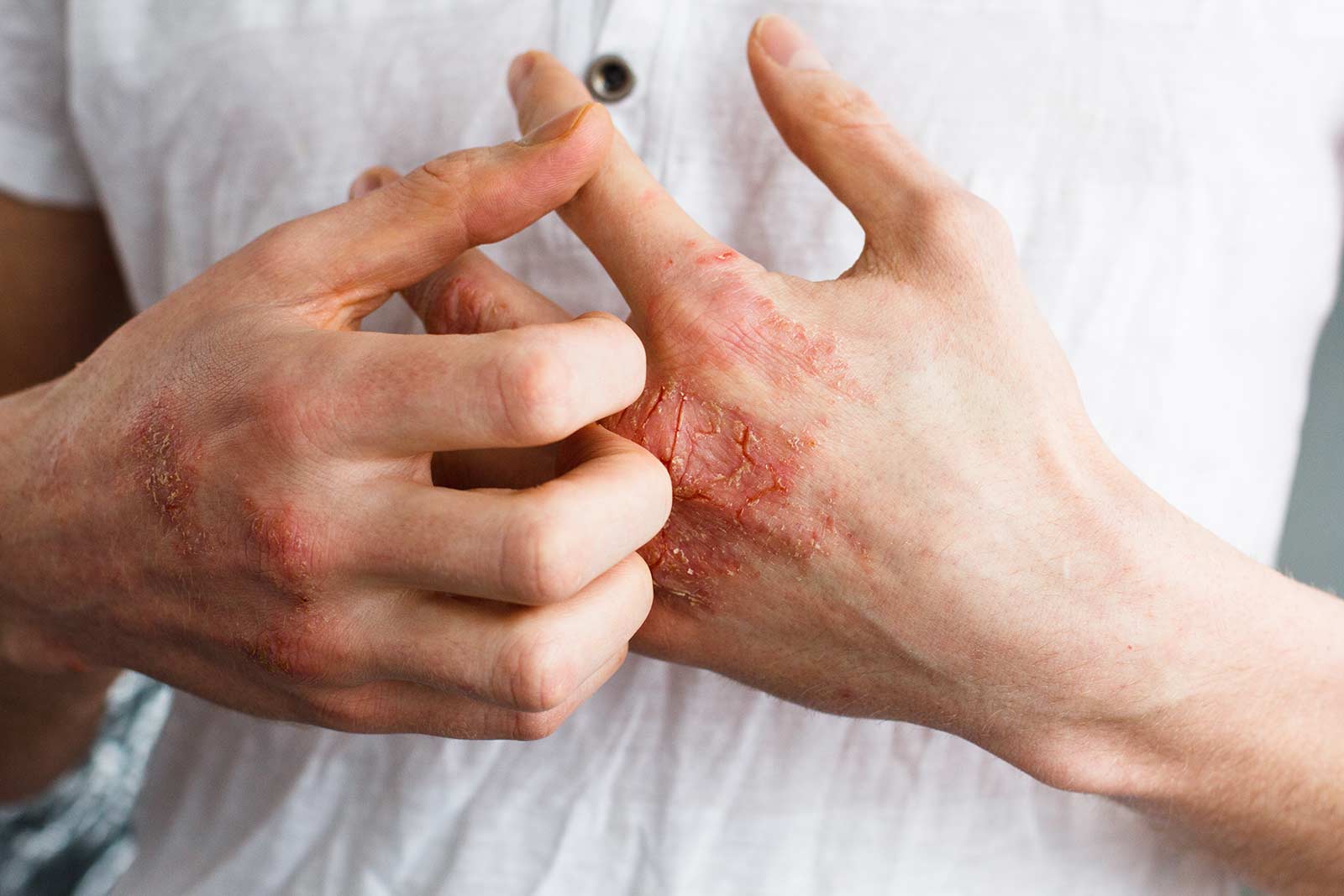 Schuppenflechte wirksam behandeln Schuppenflechte wirksam behandeln, Psoriasis