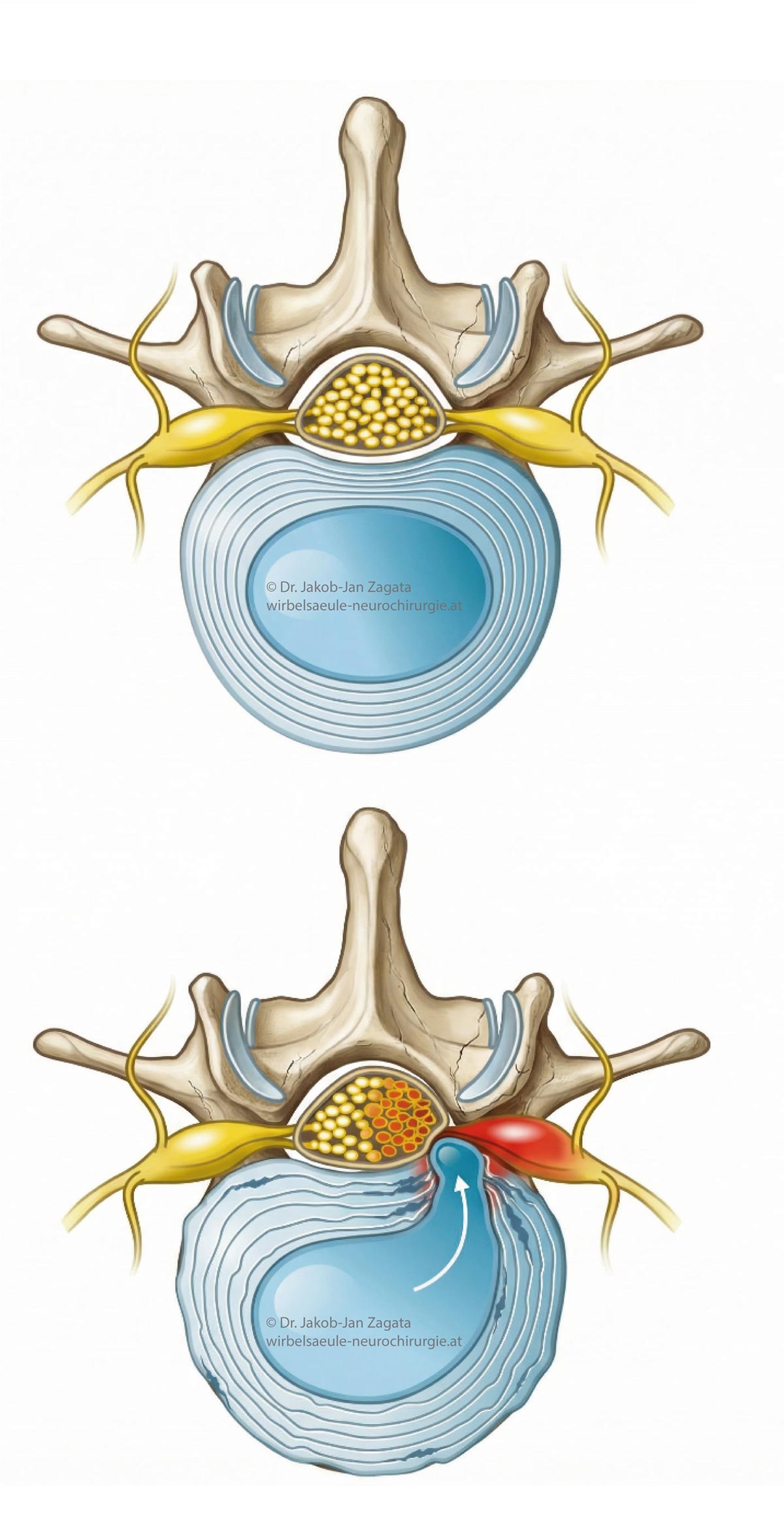 discusprolapslumbal_zagata_medsyn