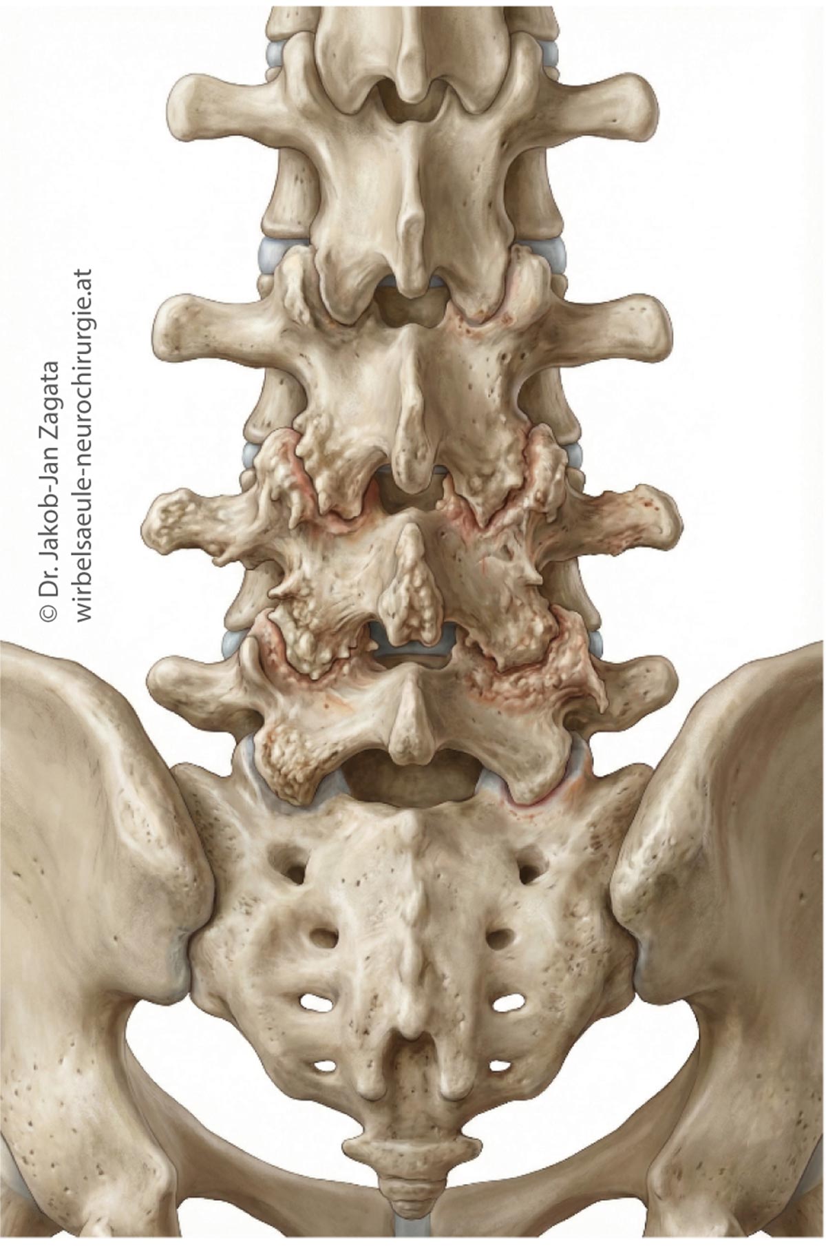 facettenarthrose_1_zagata_medsyn