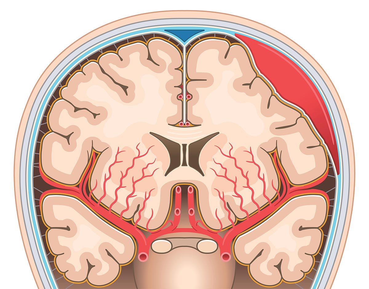 subduralhaematom_medsyn
